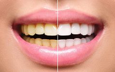 Signs When You Should Visit the Dentist