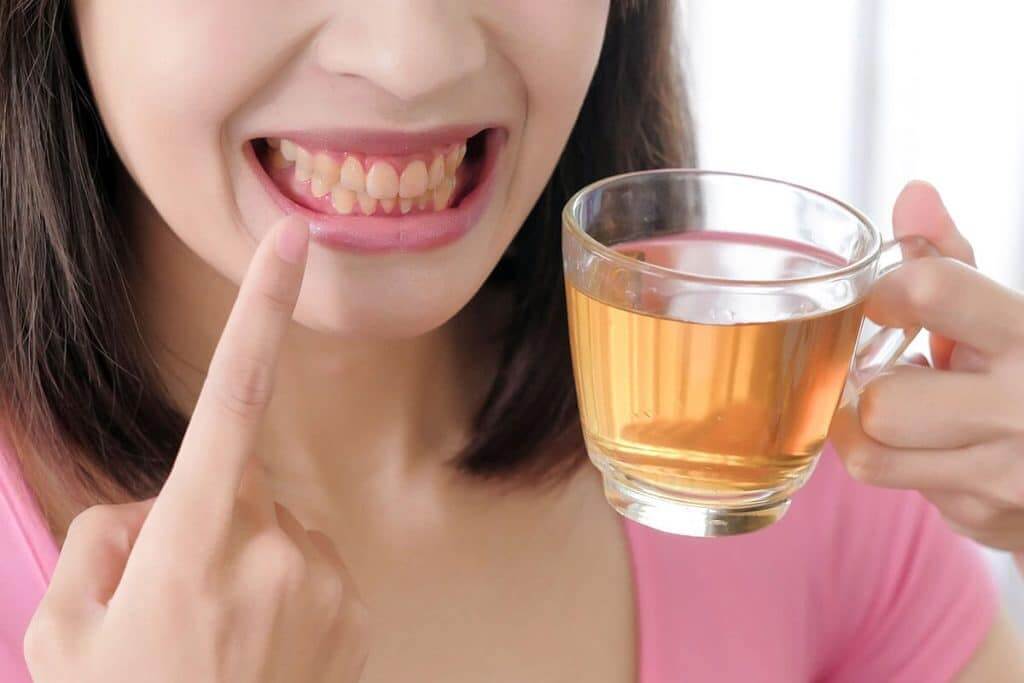 food/drinks stains (Image credit: https://www.imperialdentalassociates.com/)
