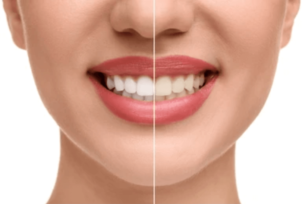 Why Do Teeth Turn Yellow